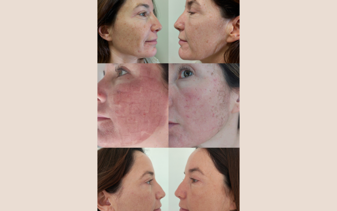 Rejuvenecimiento facial con láser CO2