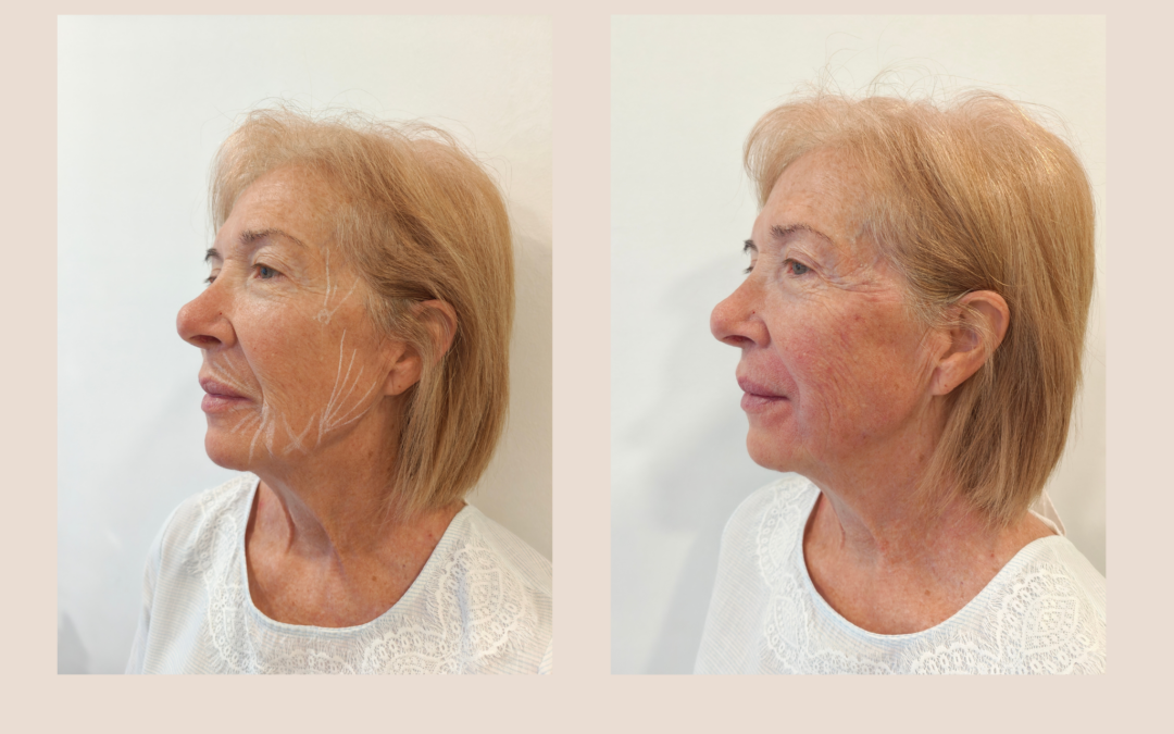 Rejuvenecimiento facial con bioestimuladores de colágeno