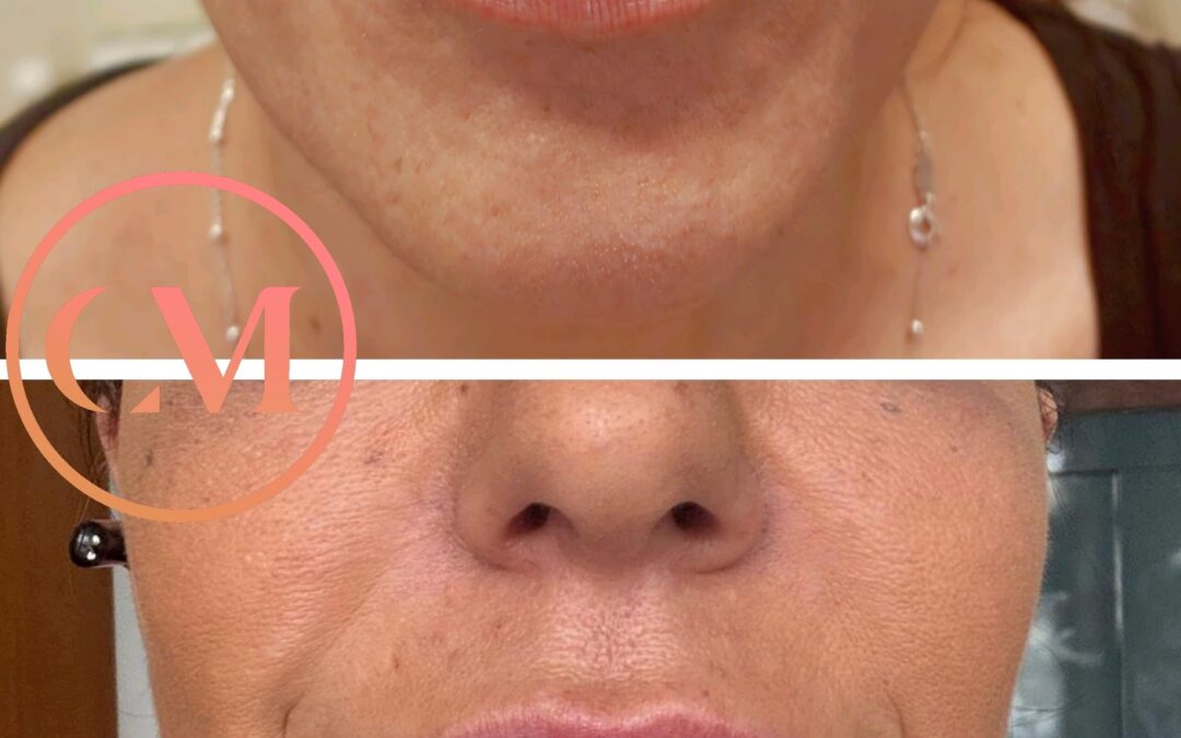 Rejuvenecimiento y aumento de labios con Acido hialurónico